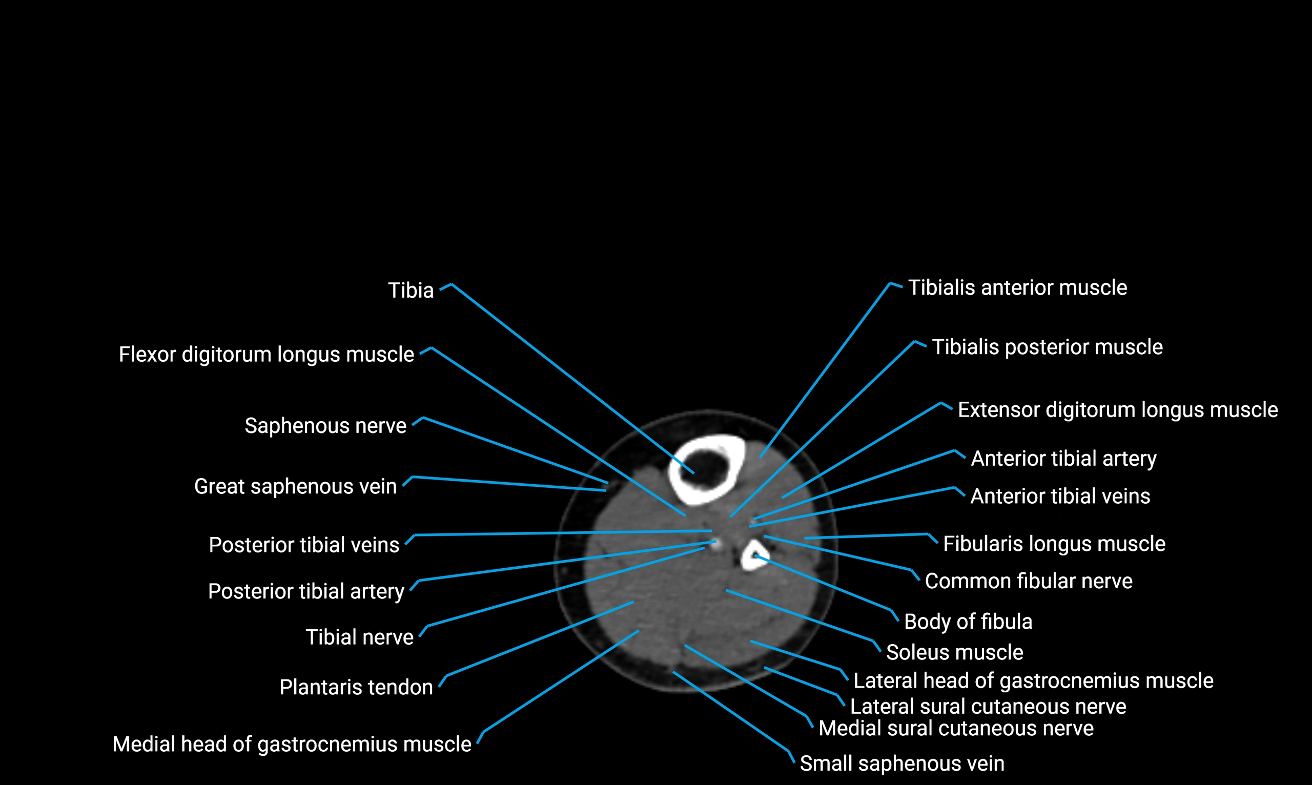 CT lower limb axial cross sectional anatomy labelled image 107 (2).webp